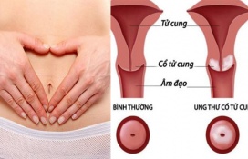 Ung thư cổ tử cung: Nguyên nhân, triệu chứng và cách phòng ngừa
